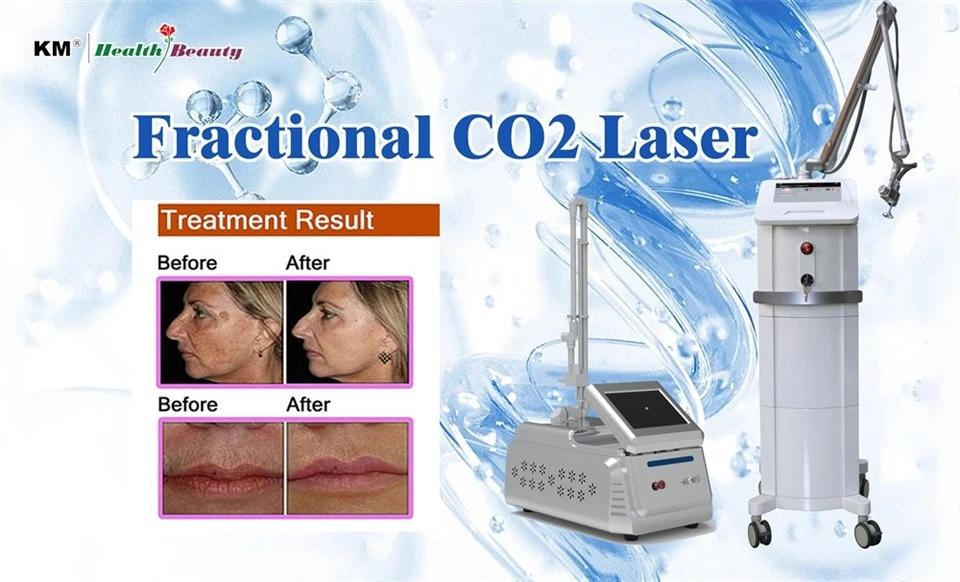 Choose KM Pico ND Yag Laser Or Fractional CO2 suppliers